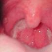 Скопление слизи в горле: причины, симптомы, лечение Почему образуется слизь в горле