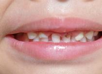 Надо ли лечить кариес молочных зубов у детей раннего возраста и как это делать?