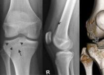 Диагностика и лечение травм мыщелка большеберцовой кости Компрессионный перелом медиального мыщелка большеберцовой кости